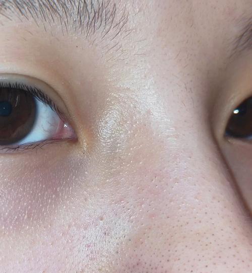 鼻子上的黑头小妙招大揭秘（无惧黑头困扰）